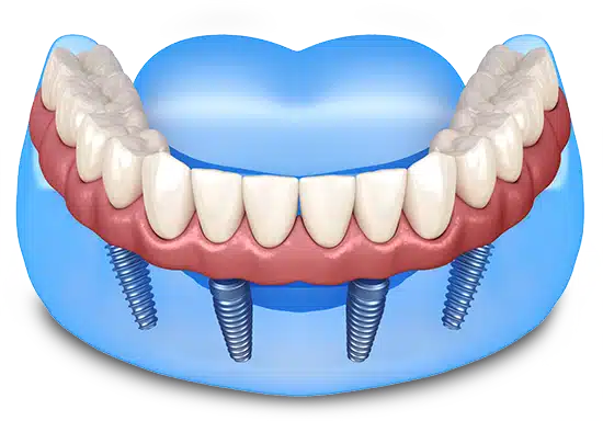Dental implant illustration showing prosthetic teeth attached to four titanium implants in jawbone model.