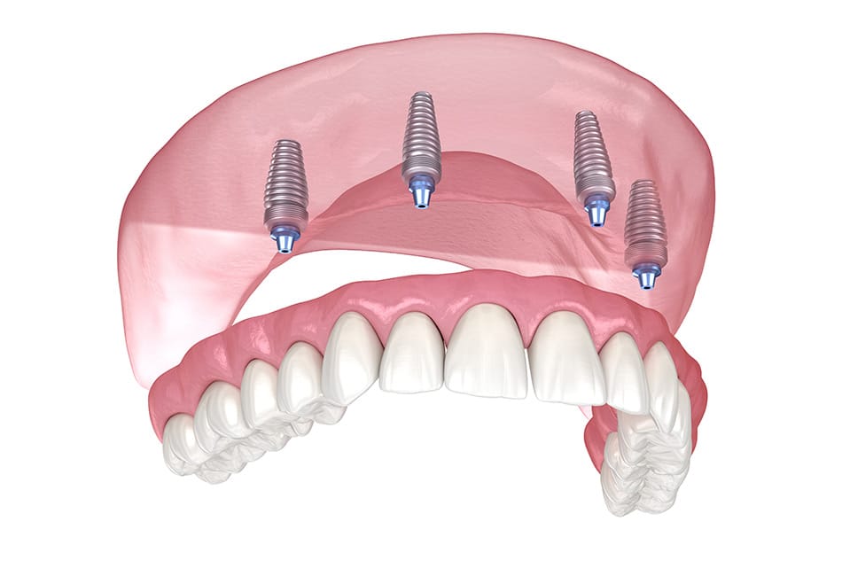 All-on-4 dental implant prosthesis showing four titanium implants supporting a full upper arch restoration.