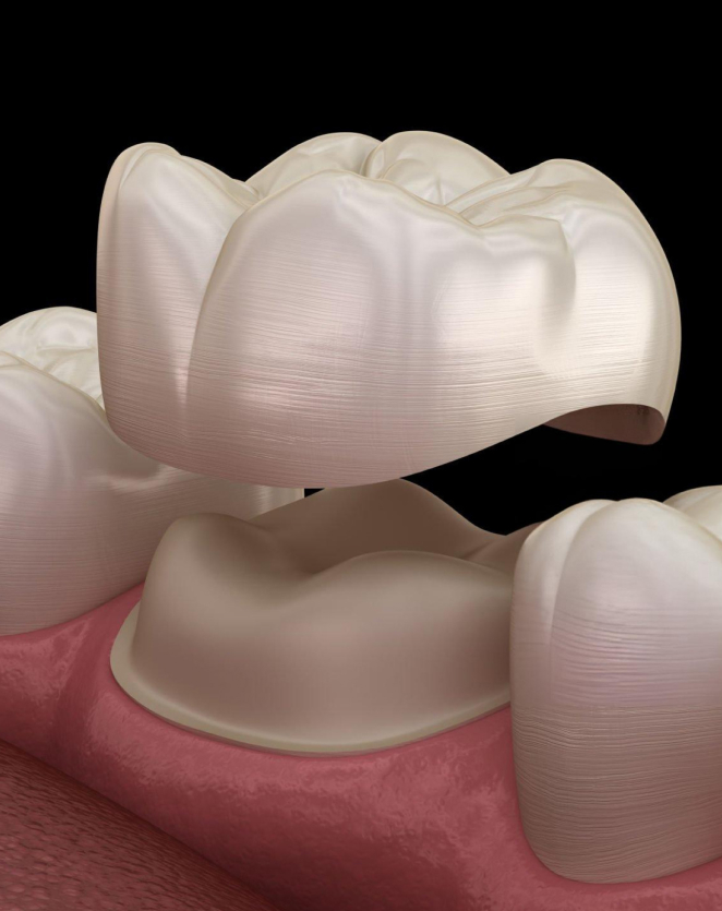 Dental crown restoration displayed on pink gum model, showing prosthetic tooth placement procedure.