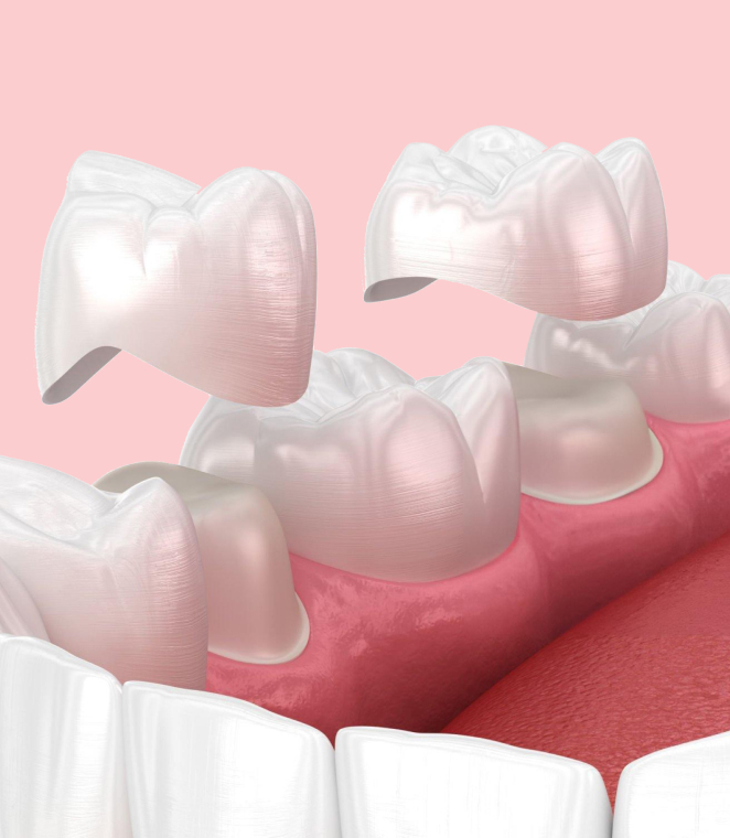 Transparent dental crowns displayed on pink gum model against pink background, dental restoration demonstration.