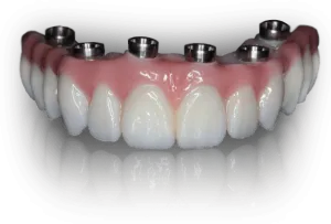 Dental implant bridge model showing prosthetic teeth with abutments on pink gum tissue.
